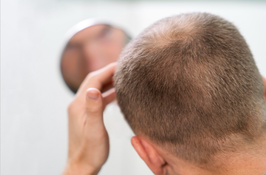 What Makes Cosmetic Clinic Melbourne Suitable for Hair Loss